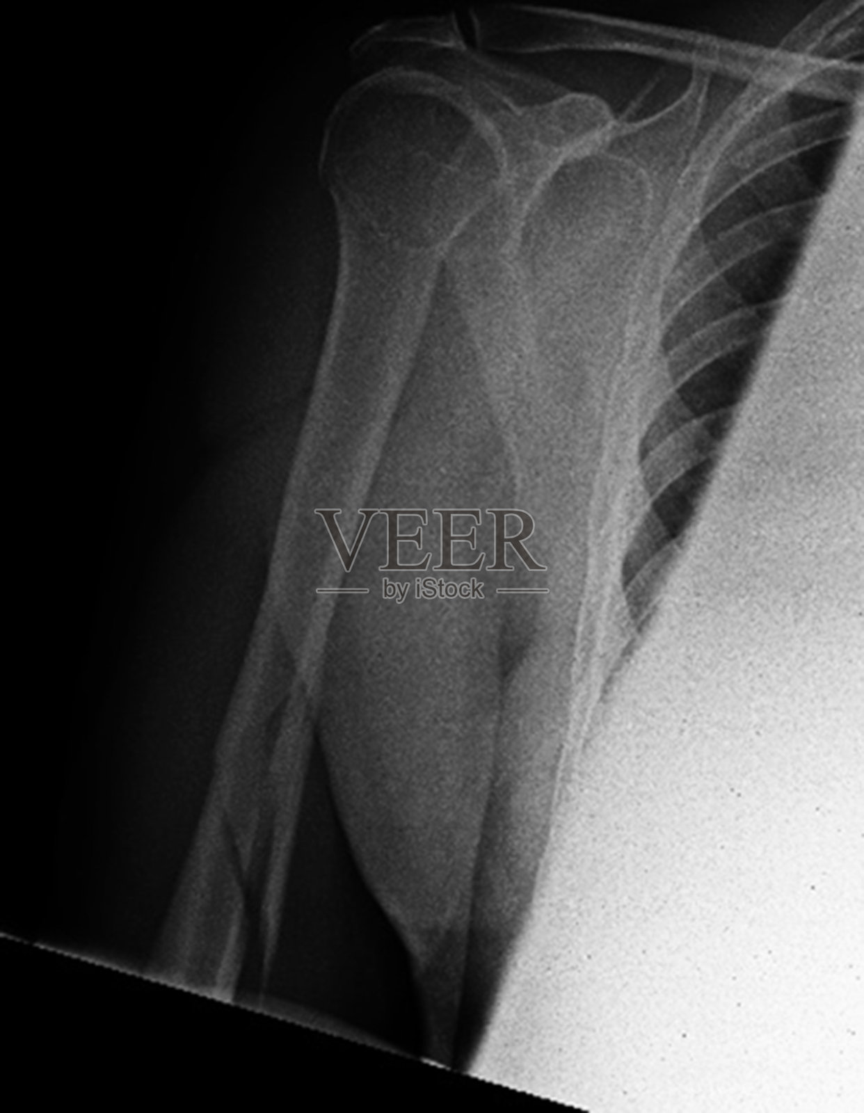 x线骨折肱骨3照片摄影图片