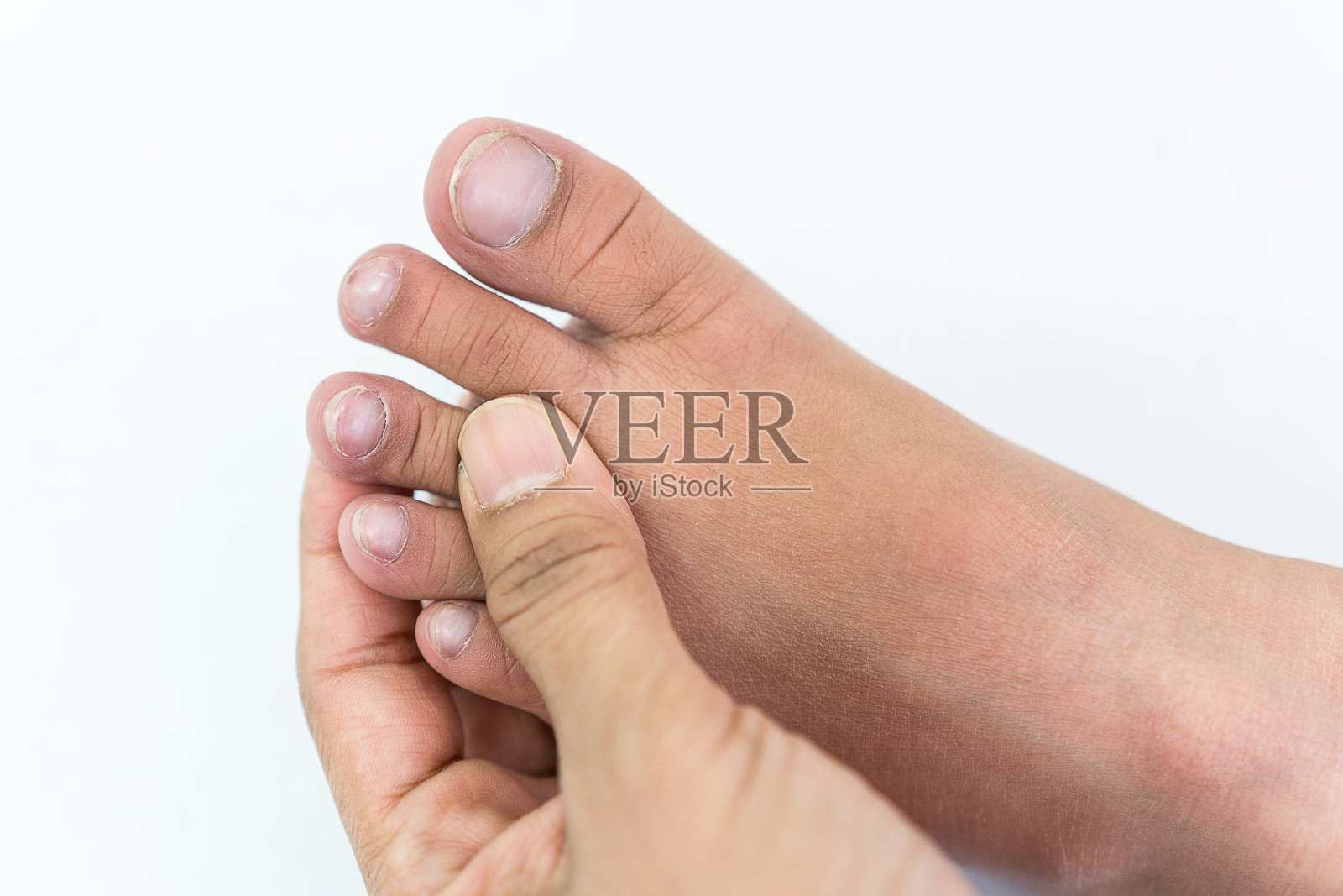 医生检查病人的脚趾甲，因为孩子不寻常的指甲可以告诉疾病的症状。照片摄影图片