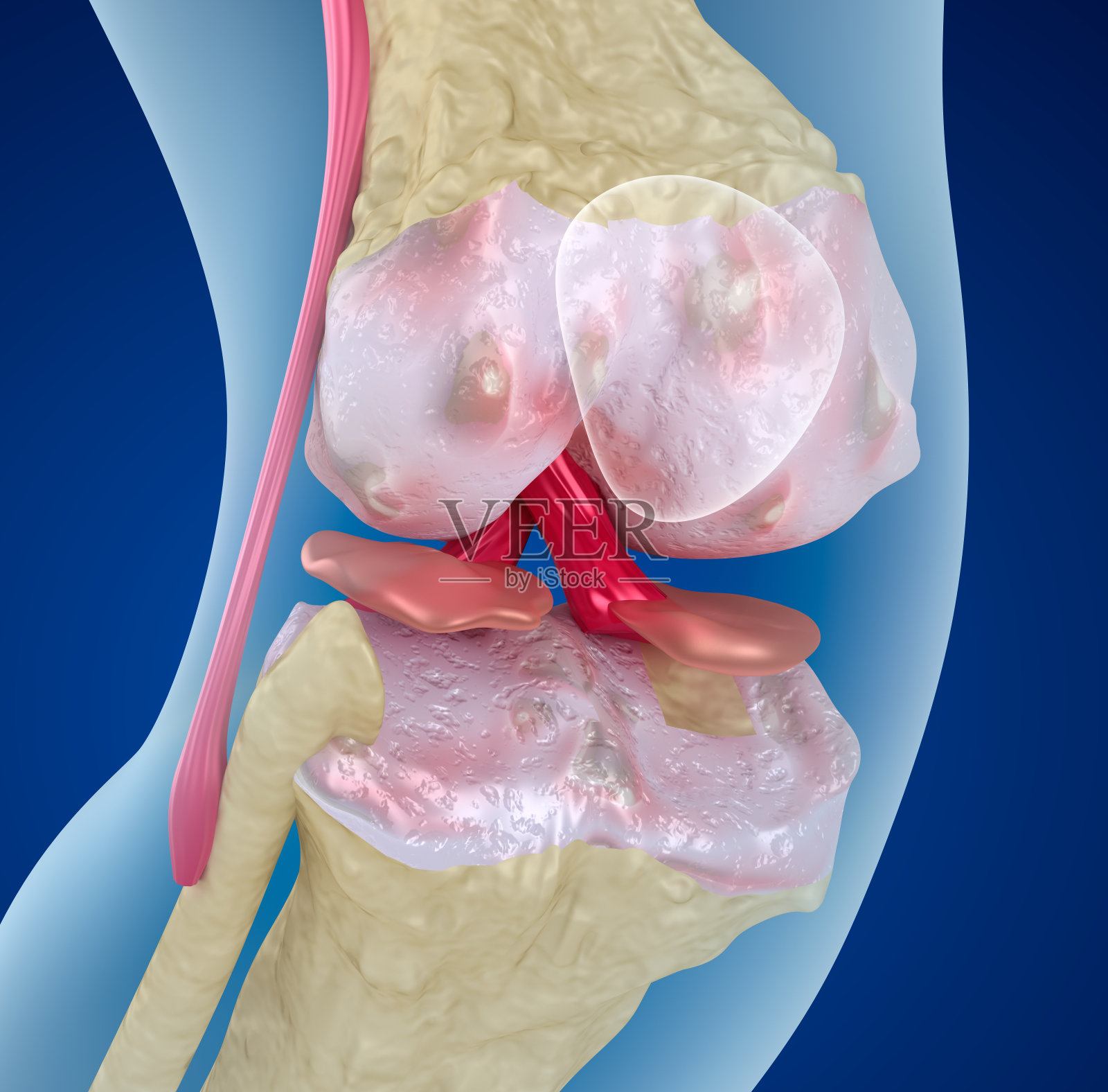 膝关节骨质疏松症，医学上精确的3D插图照片摄影图片