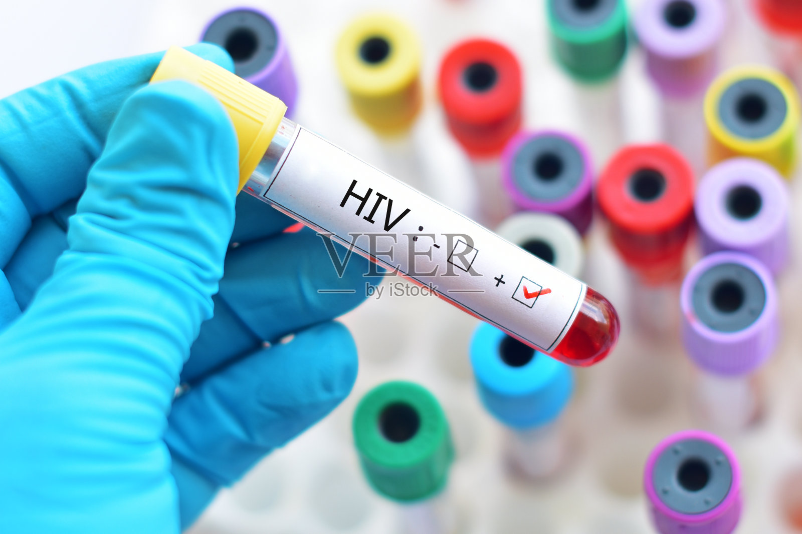 艾滋病检查结果的阴性和阳性各代表什么含意_艾滋病检测_艾测网