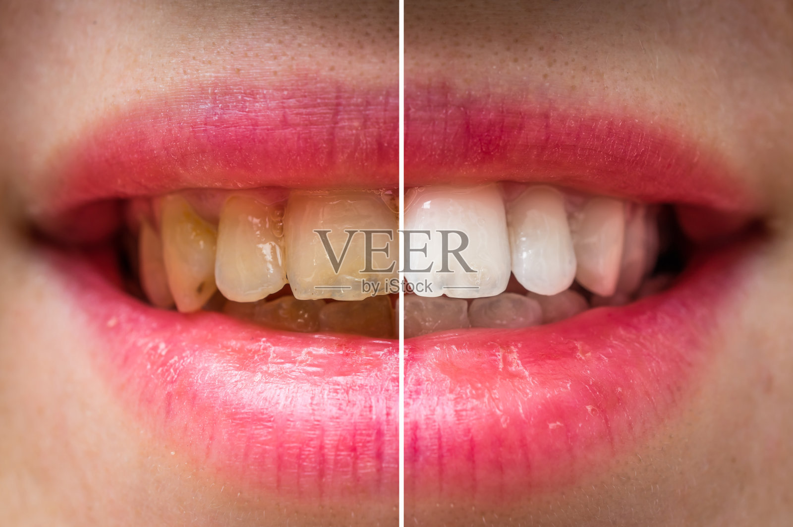 妇女牙齿治疗前后照片摄影图片