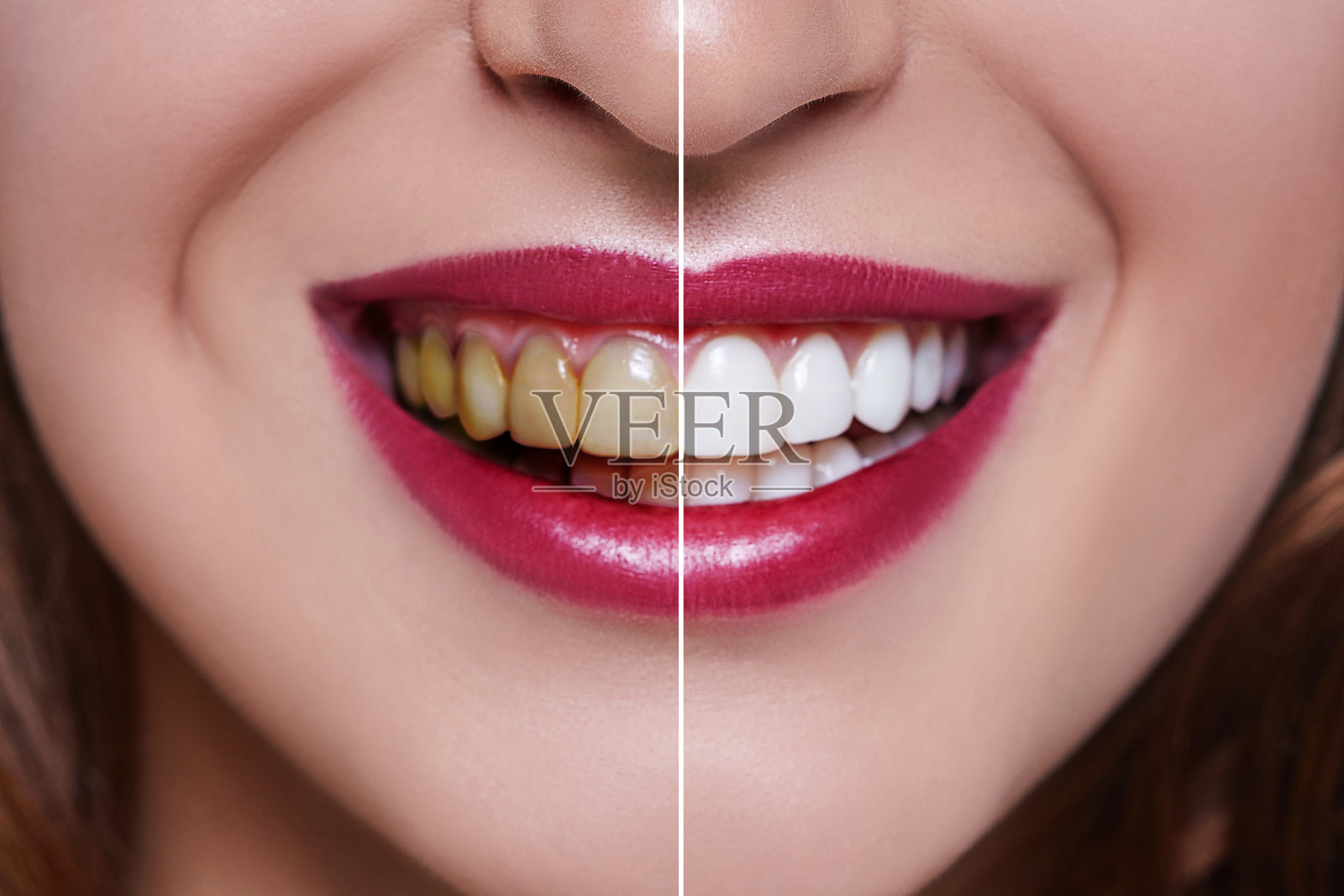 妇女牙齿治疗前后。牙齿美白。快乐微笑的女人。牙齿健康的概念。口腔护理，牙齿修复。坏的牙齿。照片摄影图片