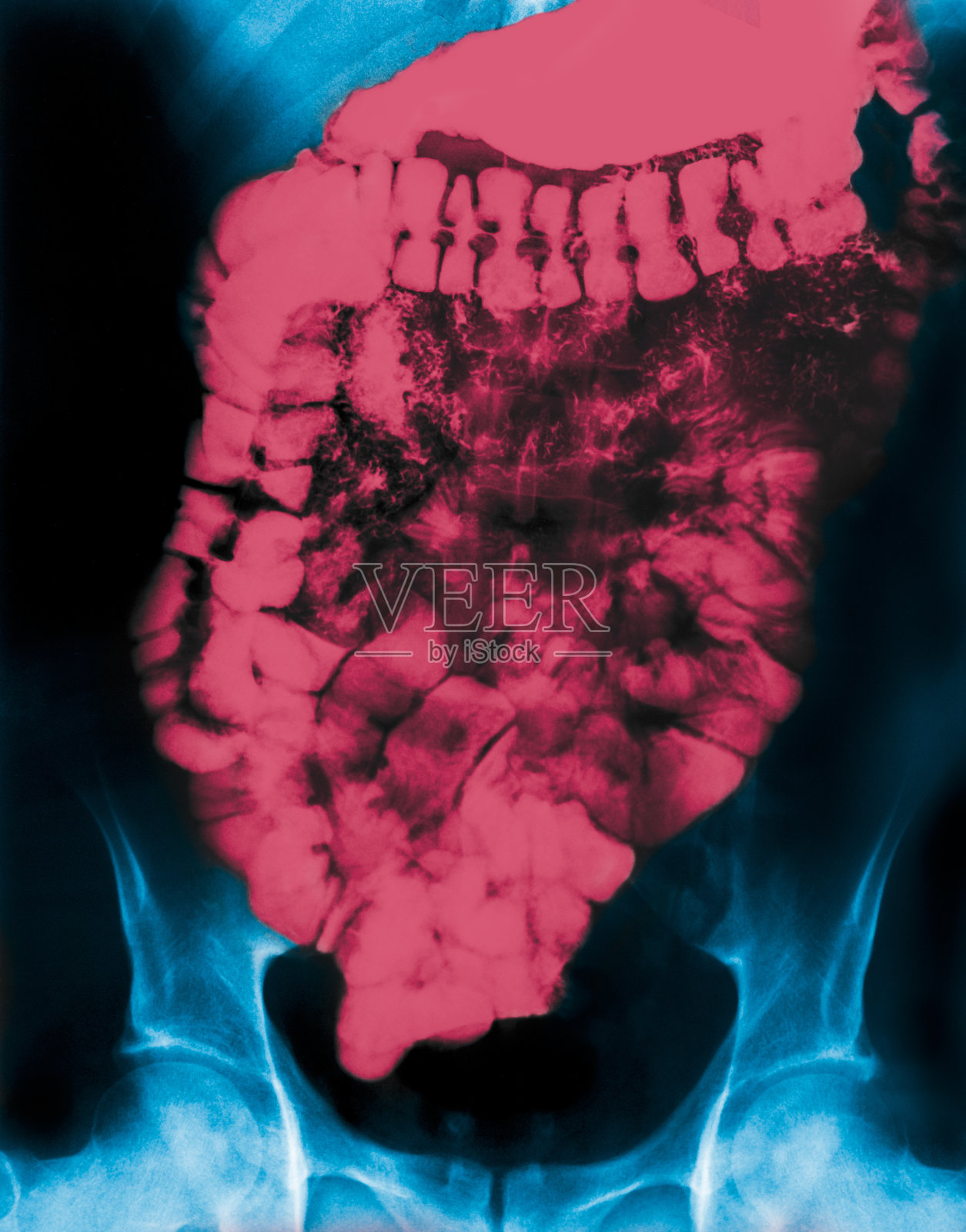 人类肠道的钡x光片，用红色突出显示照片摄影图片