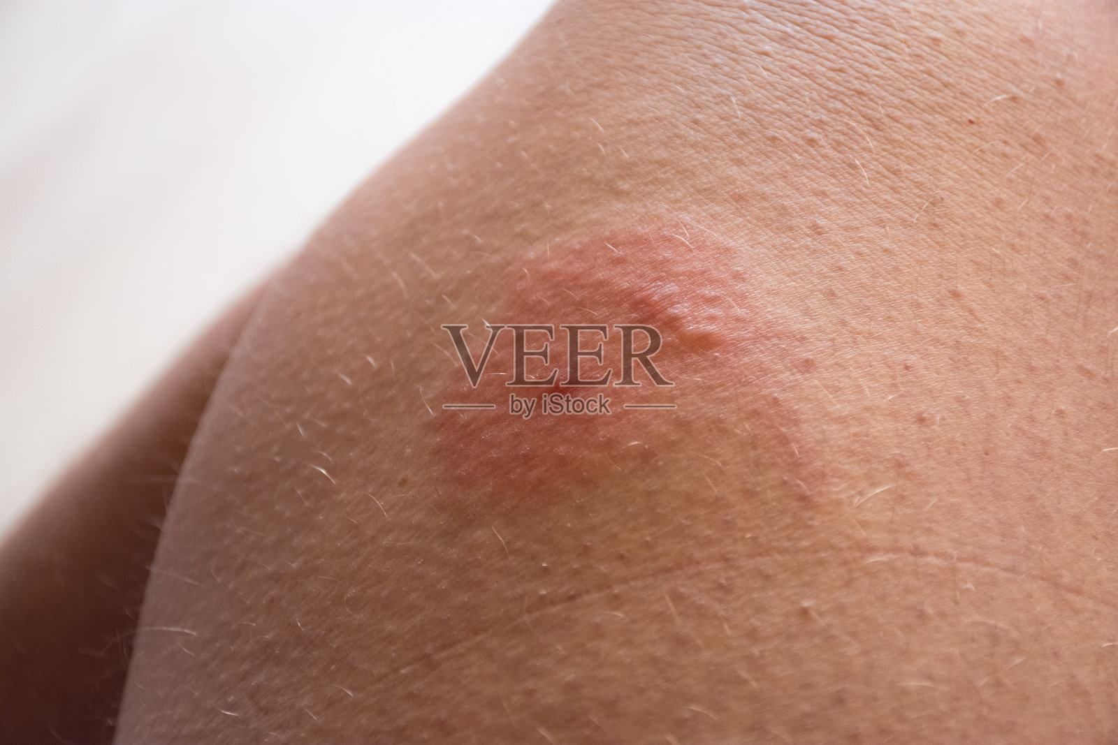 皮肤被昆虫咬伤的照片。双虫叮咬(蜜蜂、黄蜂、马蝇)，皮肤发红、发炎、过敏性肿胀或水肿。虫刺皮肤损伤的迹象和症状照片摄影图片