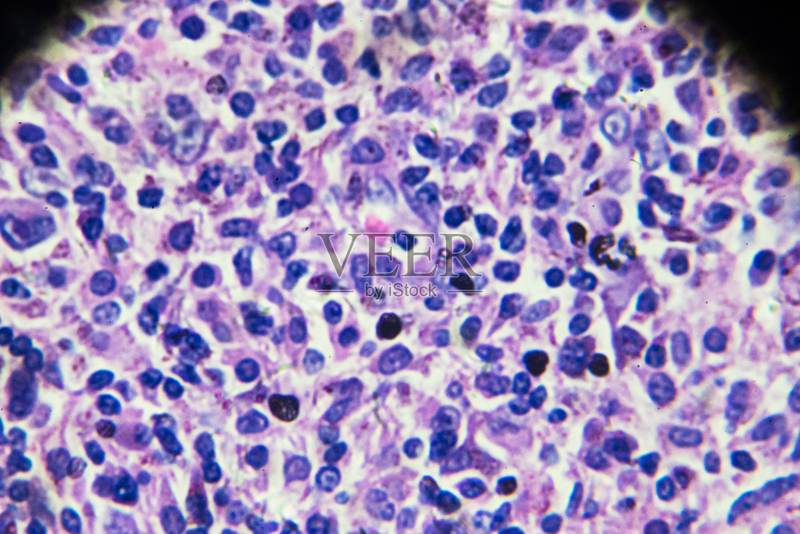 显微镜下的非霍奇金淋巴瘤照片摄影图片