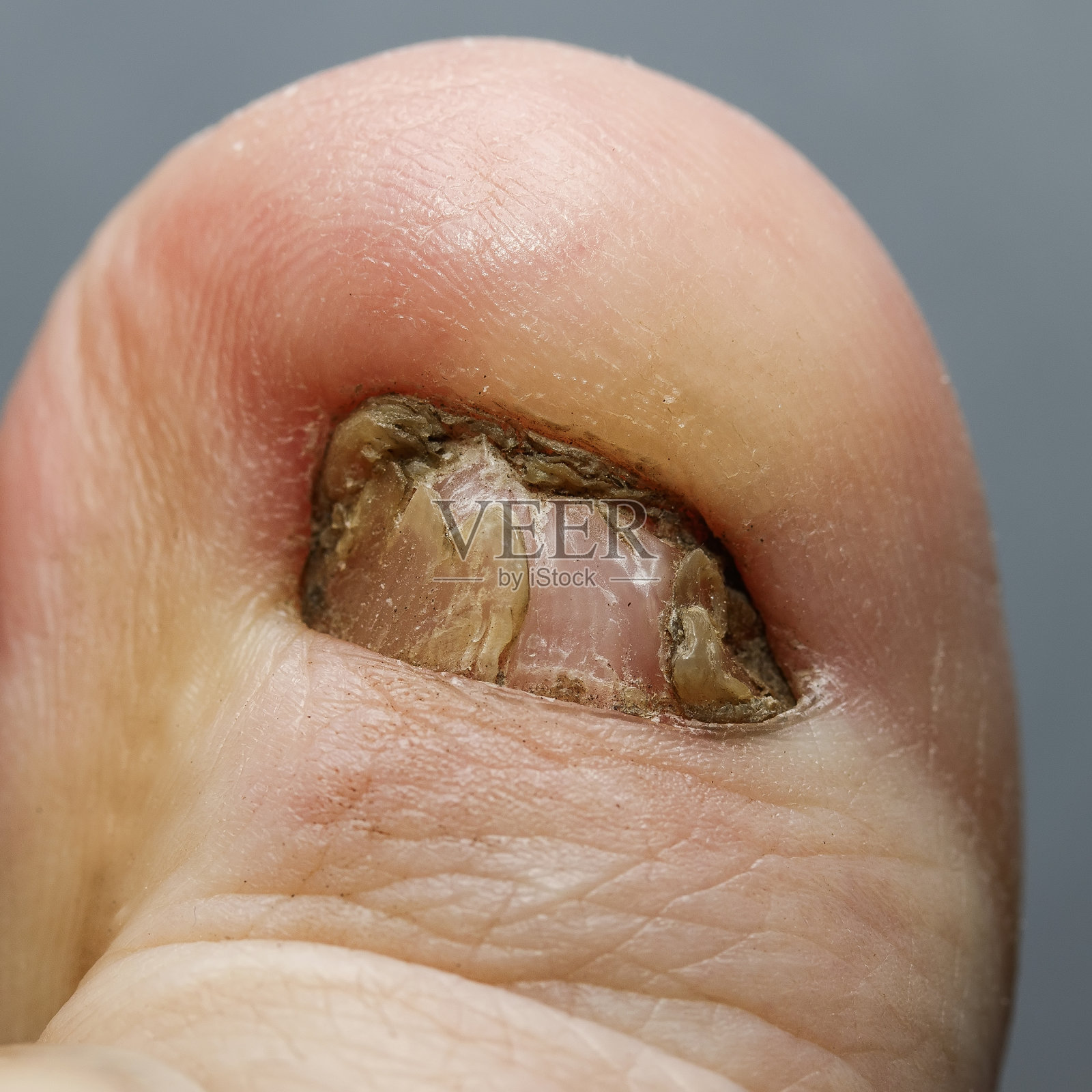 丑陋的大脚趾，指甲受真菌影响照片摄影图片