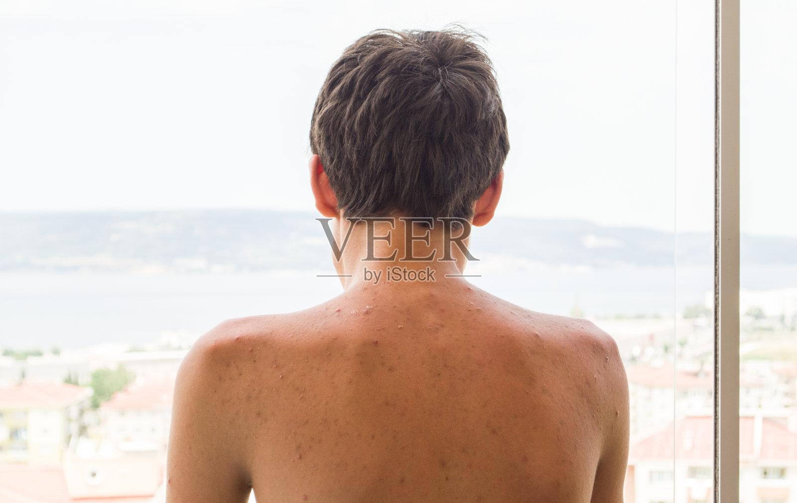 青春痘皮肤在青少年的背部照片摄影图片