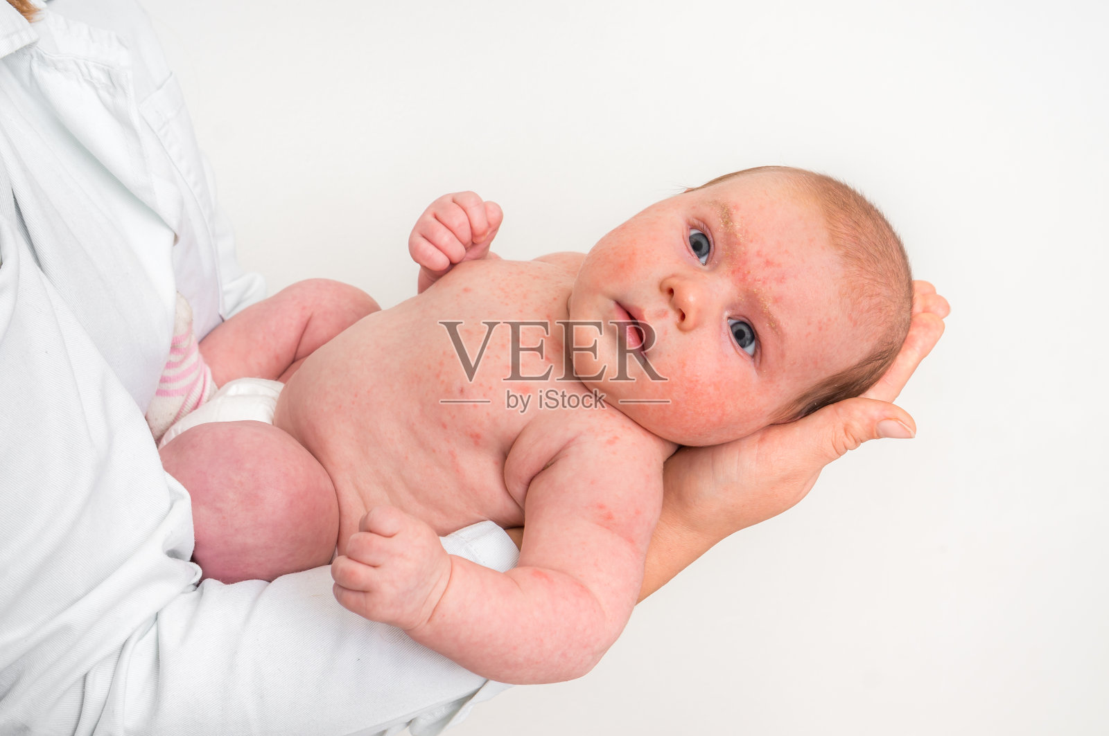 新生儿皮疹。出生后的过敏反应。照片摄影图片