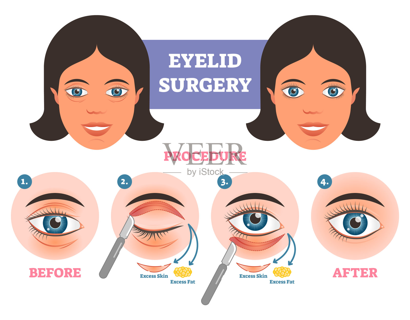 眼睑手术前、后的操作说明主要有步骤。去除多余的皮肤和脂肪。插画图片素材