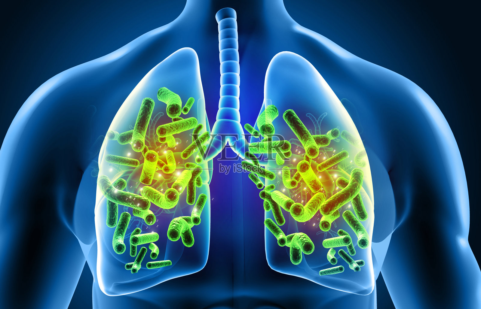 人类肺部被病毒和细菌感染照片摄影图片