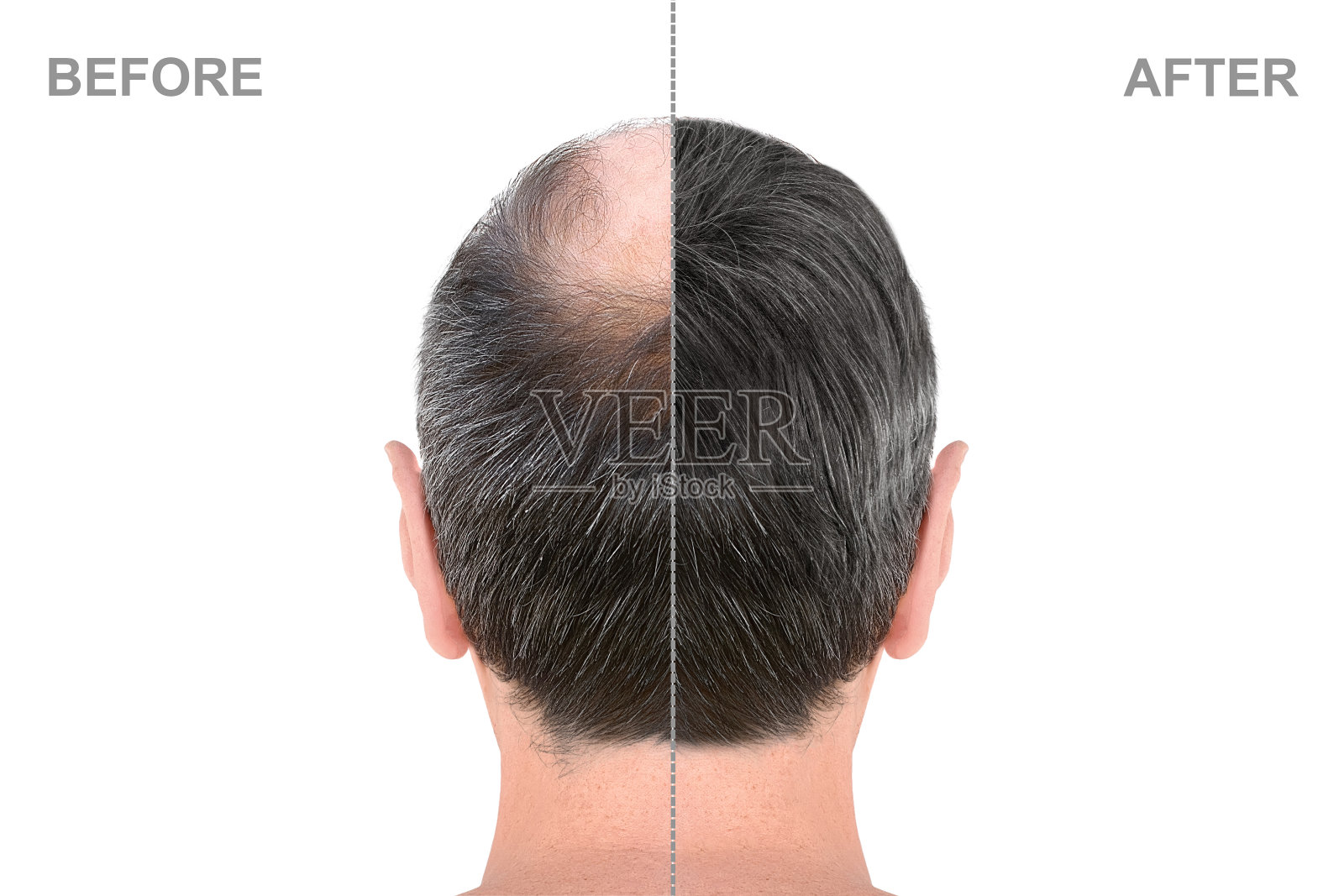 后视图的男性头部之前和之后的头发接发照片摄影图片