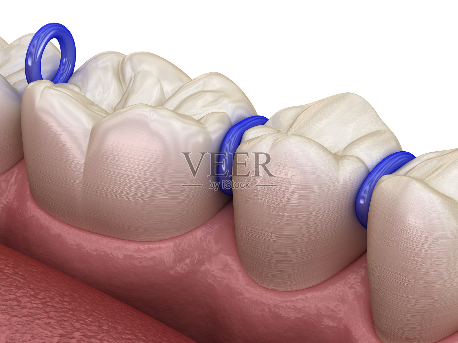 齿间橡胶分隔器，准备放置牙套。医学上准确的牙科3D插图照片摄影图片