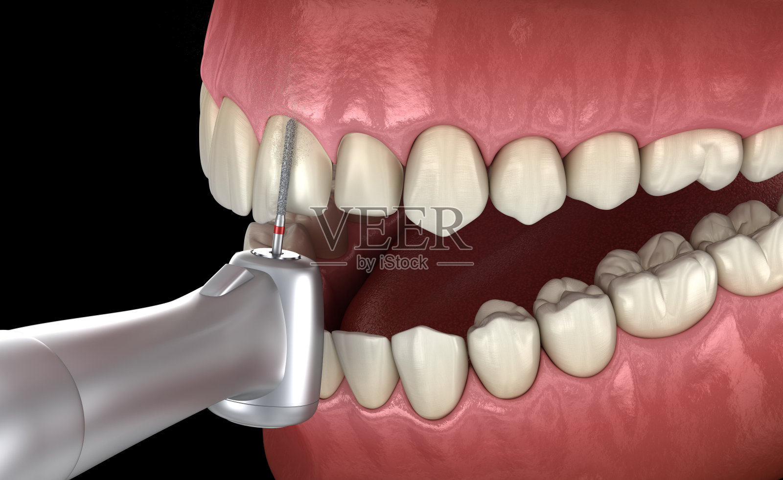 牙贴面放置的中切牙准备过程。医用精准3D插图照片摄影图片