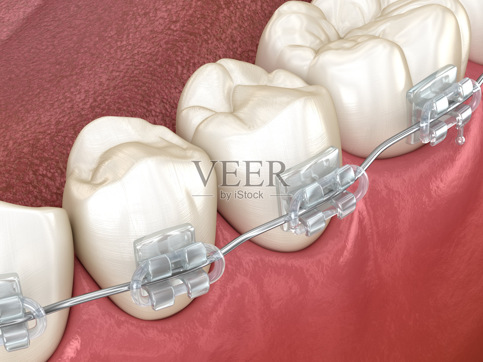 下颌和清晰的牙架。医学上准确的牙科3D插图照片摄影图片