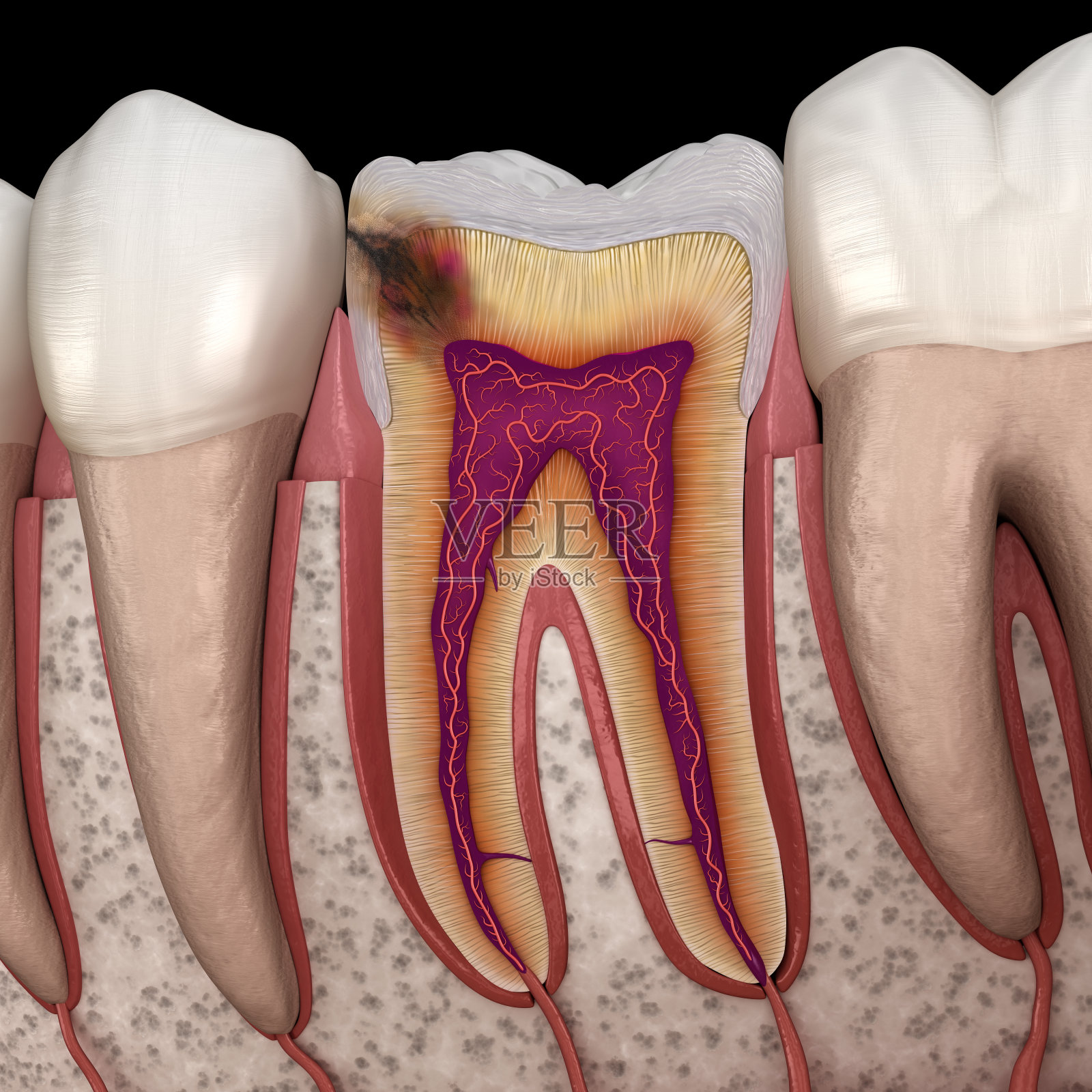 得了龋齿，什么情况可以直接补牙，什么情况又需要做根管治疗？ - 知乎
